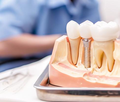 Dental implants