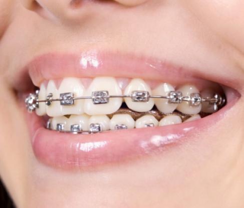 Self-ligating braces