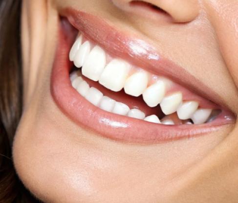 Veneers