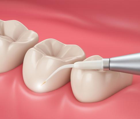 Удаление с помощью пьезохирургии